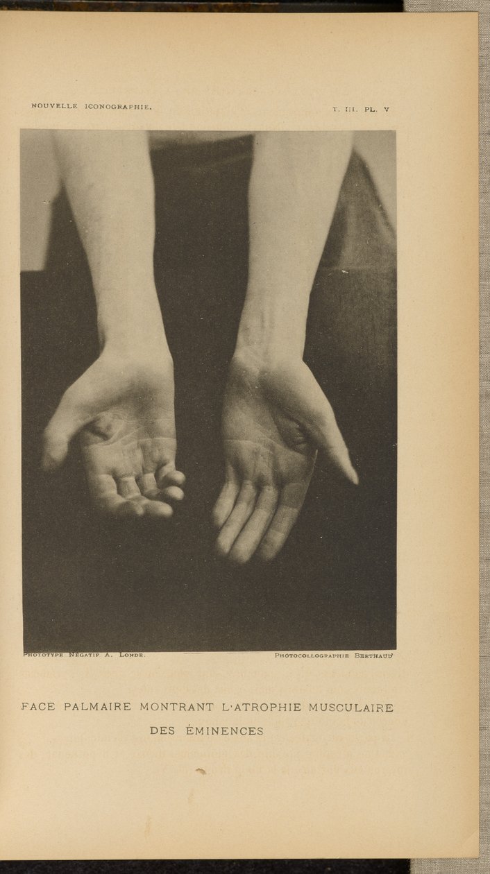  by Albert Londe
