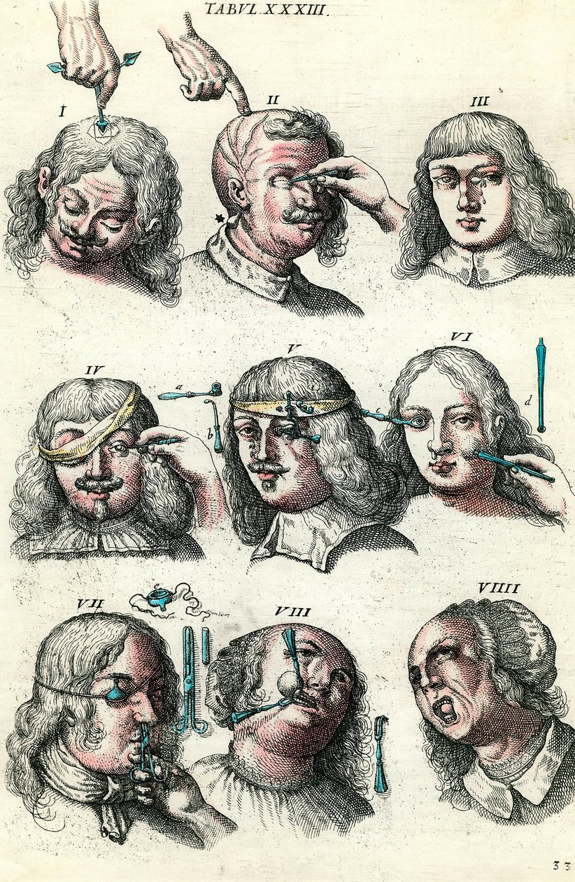 18. yüzyılda cerrahi: Göz ve yüzün trepanasyonu ve operasyonu. Lorenz Heister