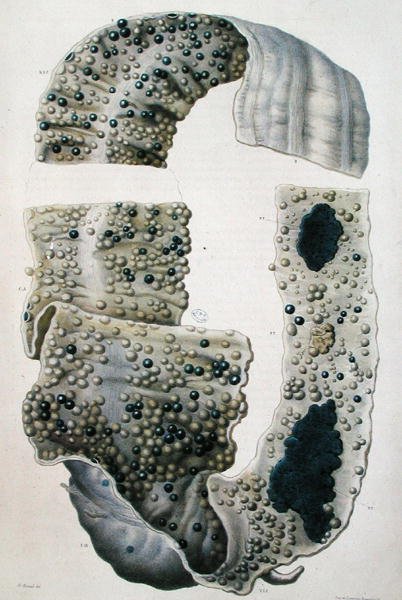 Jean Cruveilhier (1791-1874) 1828-42 (renkli gravür) tarafından 