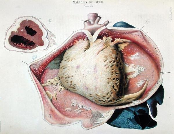 Perikardit, Jean Cruveilhier (1791-1874) tarafından Paris