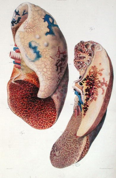 Pnömoni, Jean Cruveilhier (1791-1874) 1828-42 (renkli gravür) tarafından 