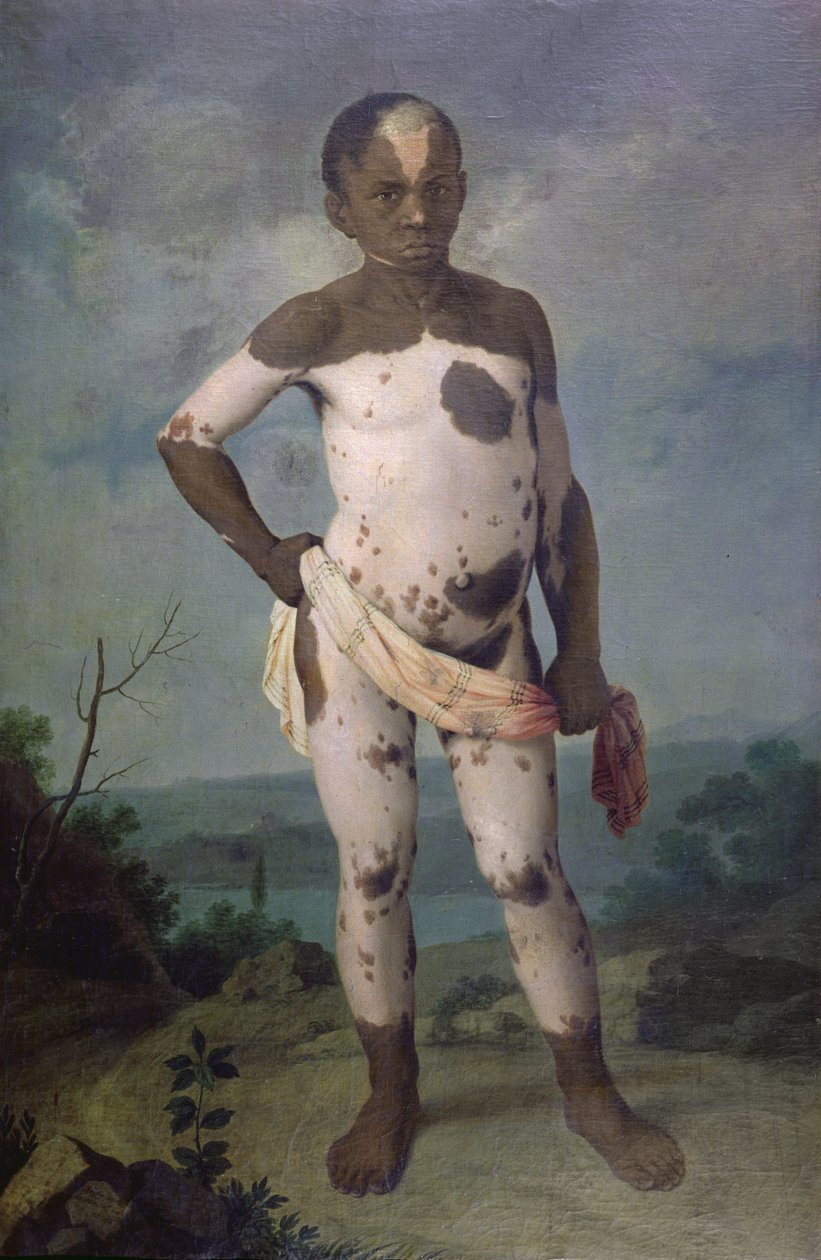 Vitiligolu Çocuk, 1786 by Brazilian School
