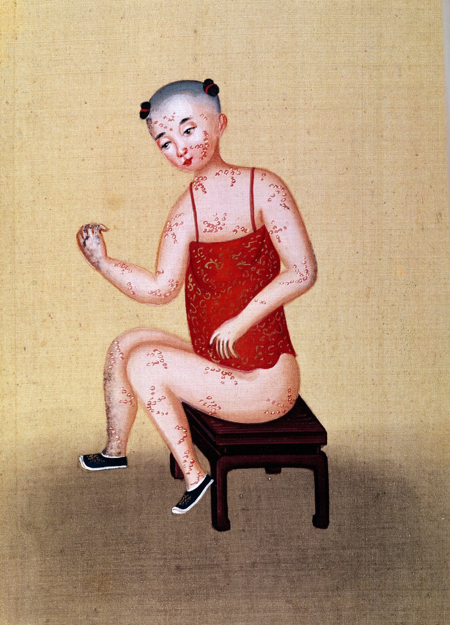Çiçek hastalığı olan çocuk (kağıt üzerinde wc) by Chinese School