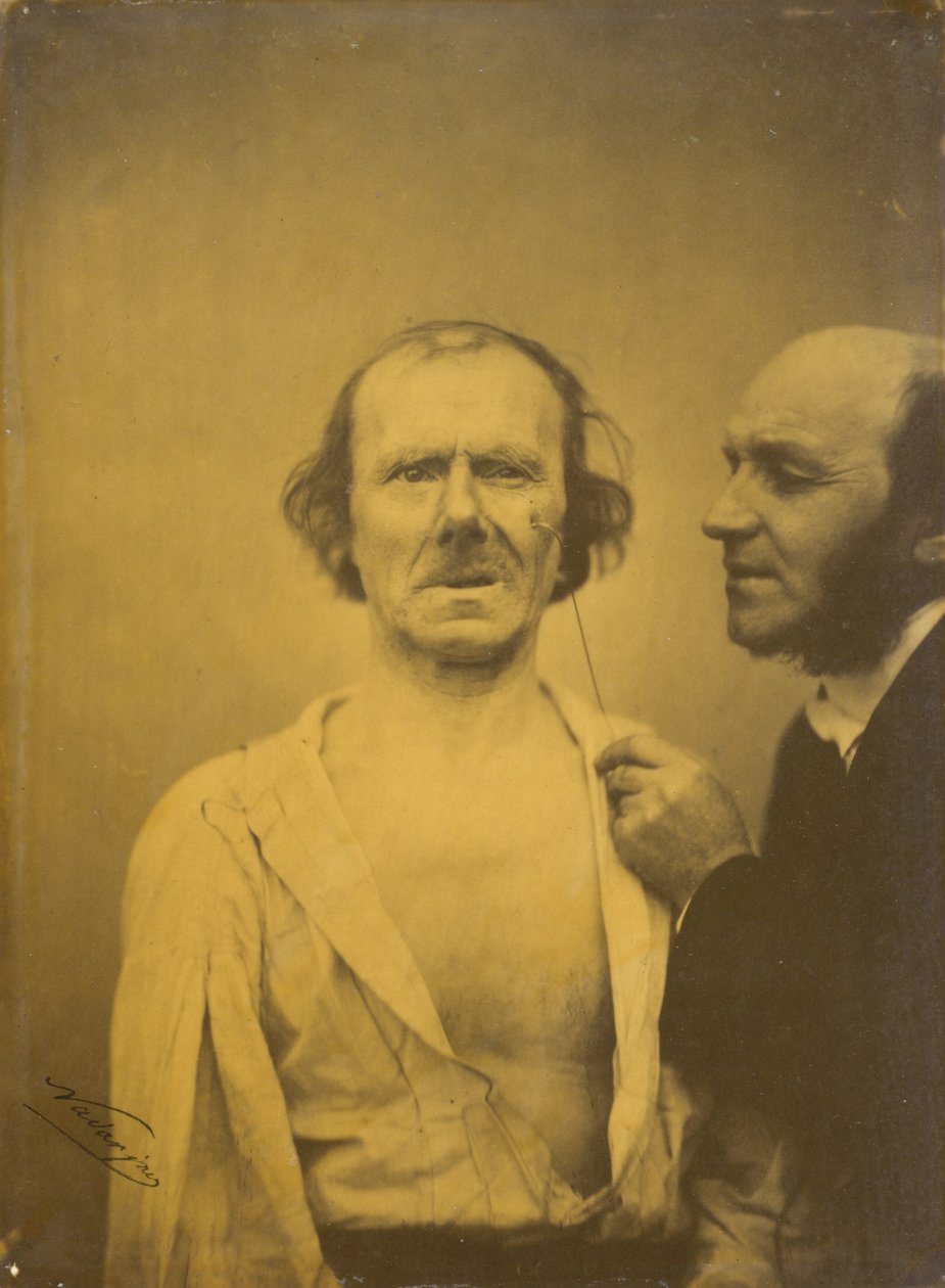 Ağlama, acıma gözyaşları kaldı, Rahat yüz sağ, 1854-1856, 1862 basıldı. by Duchenne de Boulogne