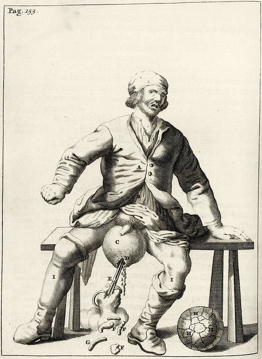 Skrotumun hidroselinden sıvının boşaltılması, by Dutch School