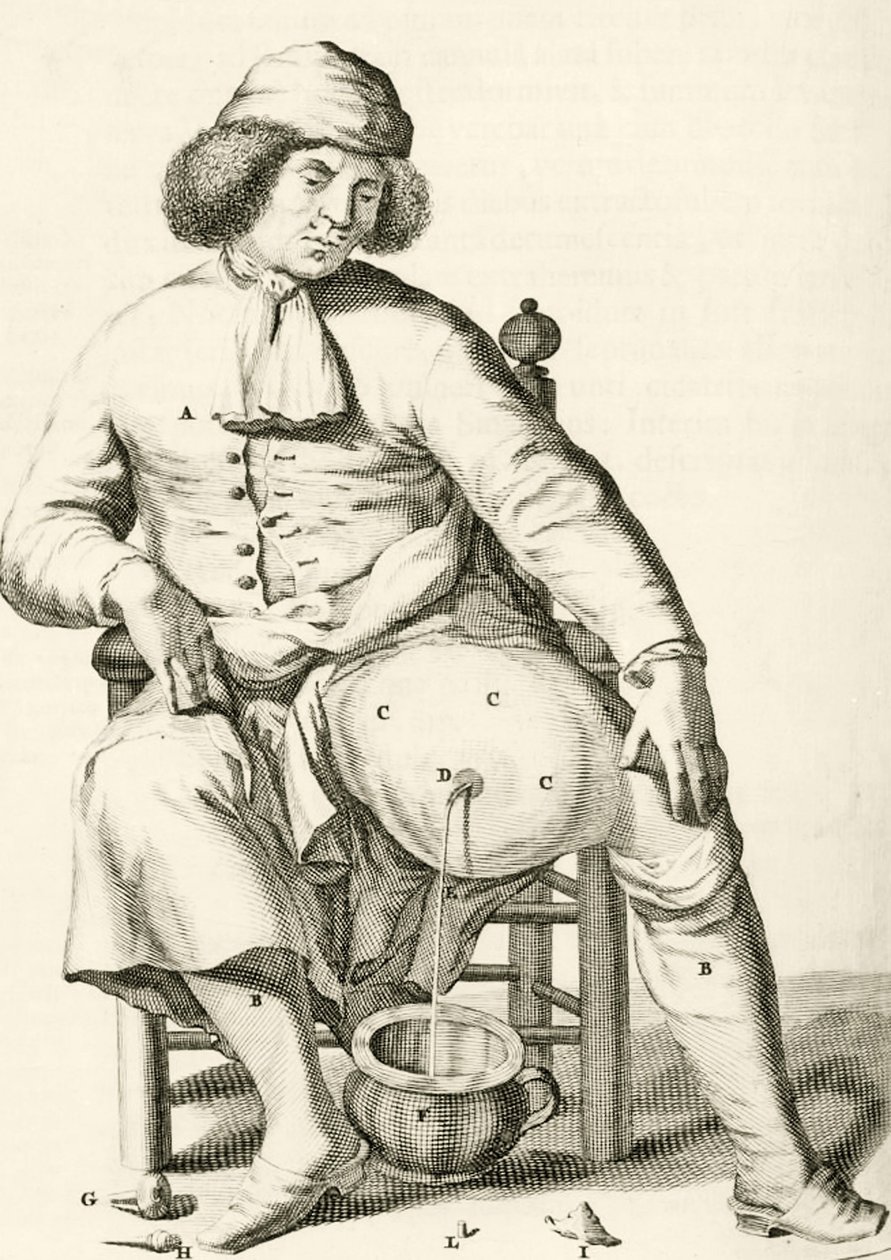 Bir apseden sıvıyı boşaltmak, Frederik Dekkers, 1694 by Dutch School