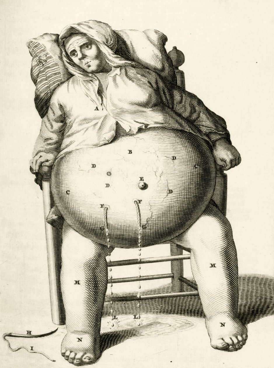 Bir apseden sıvıları boşaltmak, Frederik Dekkers, 1694 by Dutch School