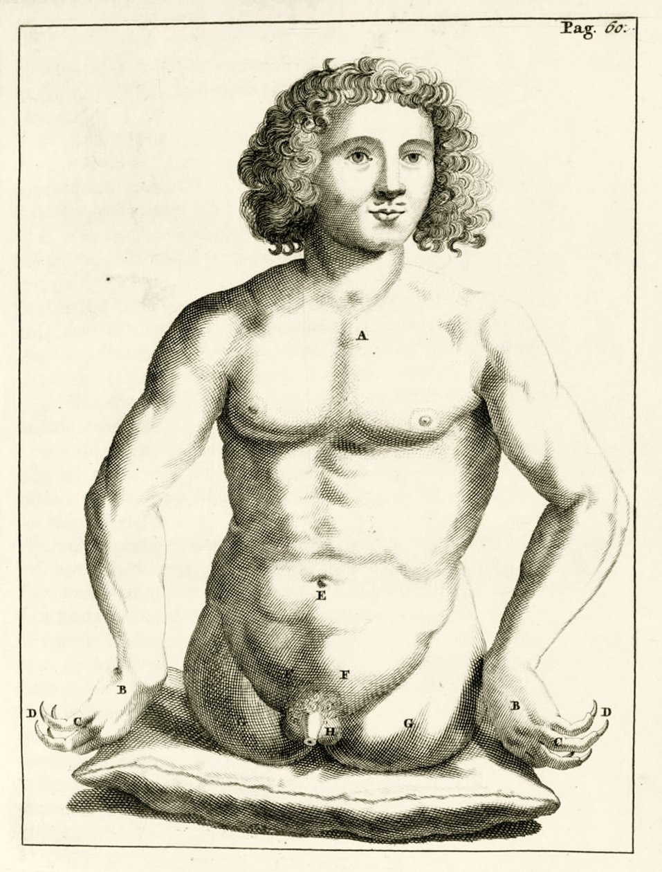 Frederik Dekkers tarafından konjenital doğum kusurları örneği, 1694 by Dutch School