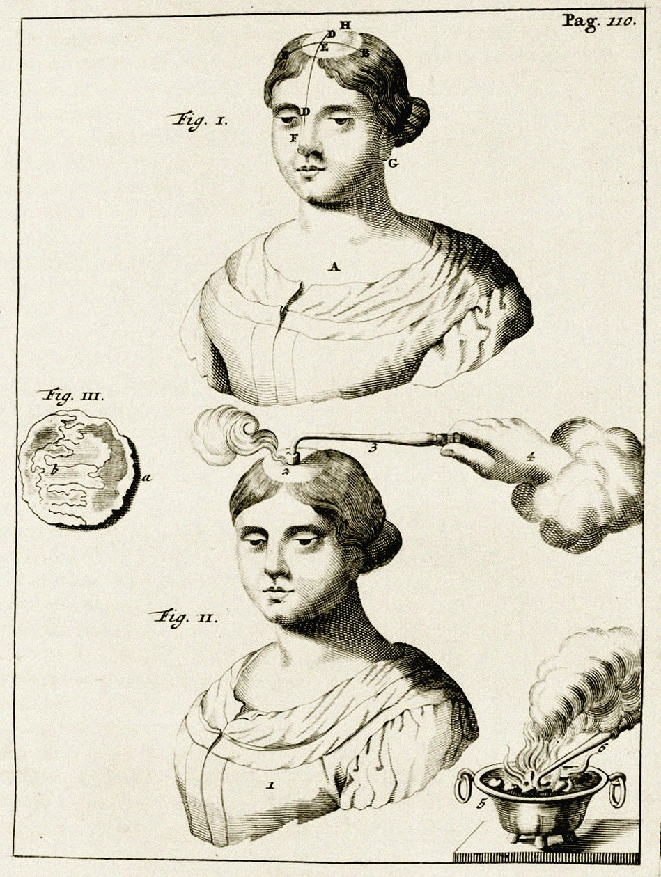 Epilepsi hastasını tedavi etmek, Frederik Dekkers, 1694 tarafından Tıp Uygulamasında Alıştırmalardan by Dutch School