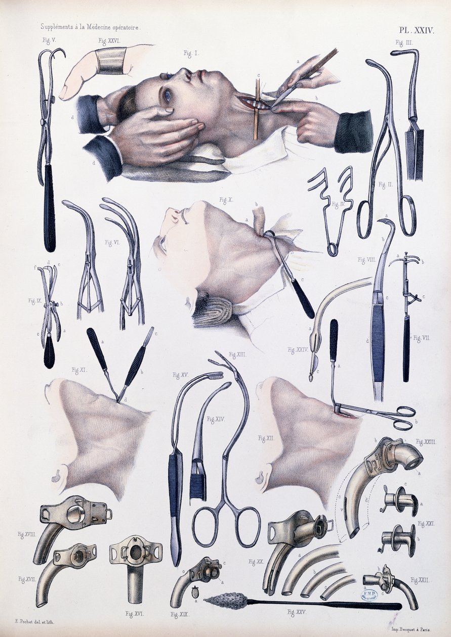 Trakeotomi operasyonu, Jean-Baptiste Marc Bourgery (1797-1849) 1866-67