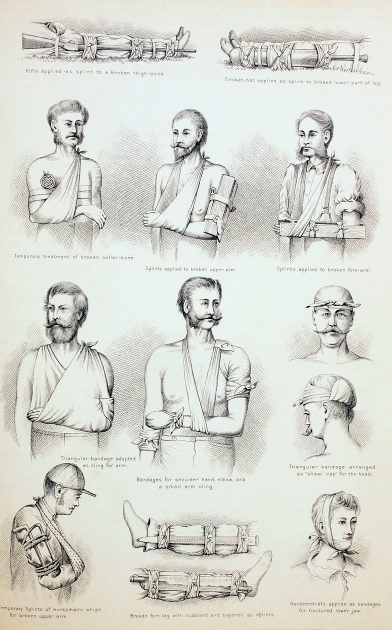 Kırıkların Geçici Tedavisi, c.1890 by English School