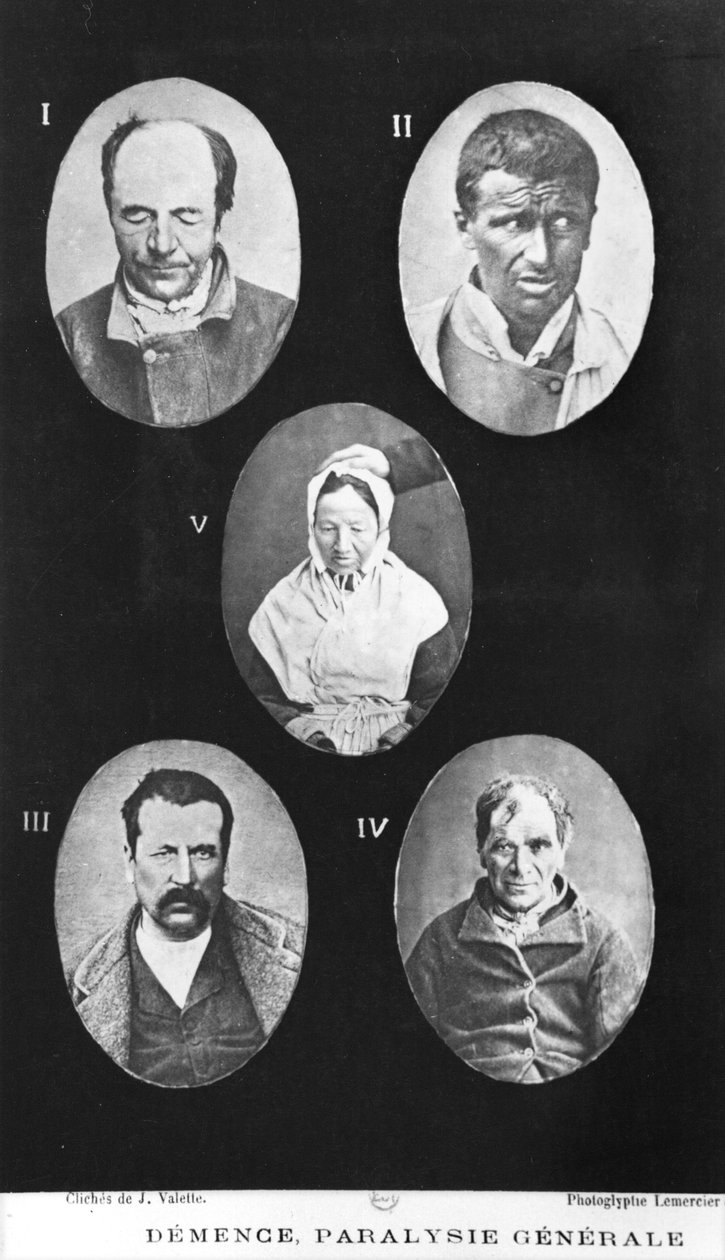 Demans, Genel Felç, Henri Dagonet (1823-1902) Paris, Bailliere, 1876 tarafından zihinsel hastalıklar üzerine yeni temel ve pratik incelemeden bir örnek by French Photographer