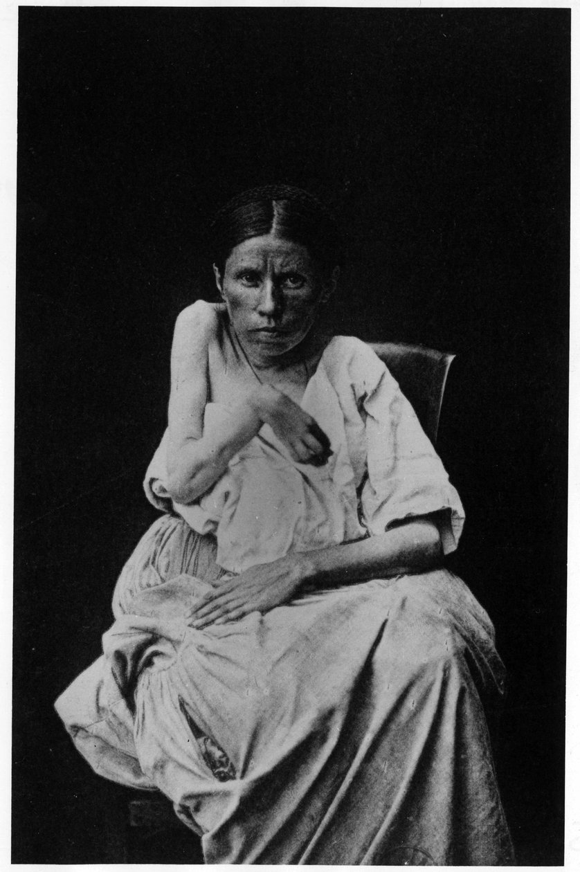 Hemiplejik epilepsiden muzdarip bir hastanın fotoğrafı, - Salpetrière, Bourneville ve P. Regnard, Paris