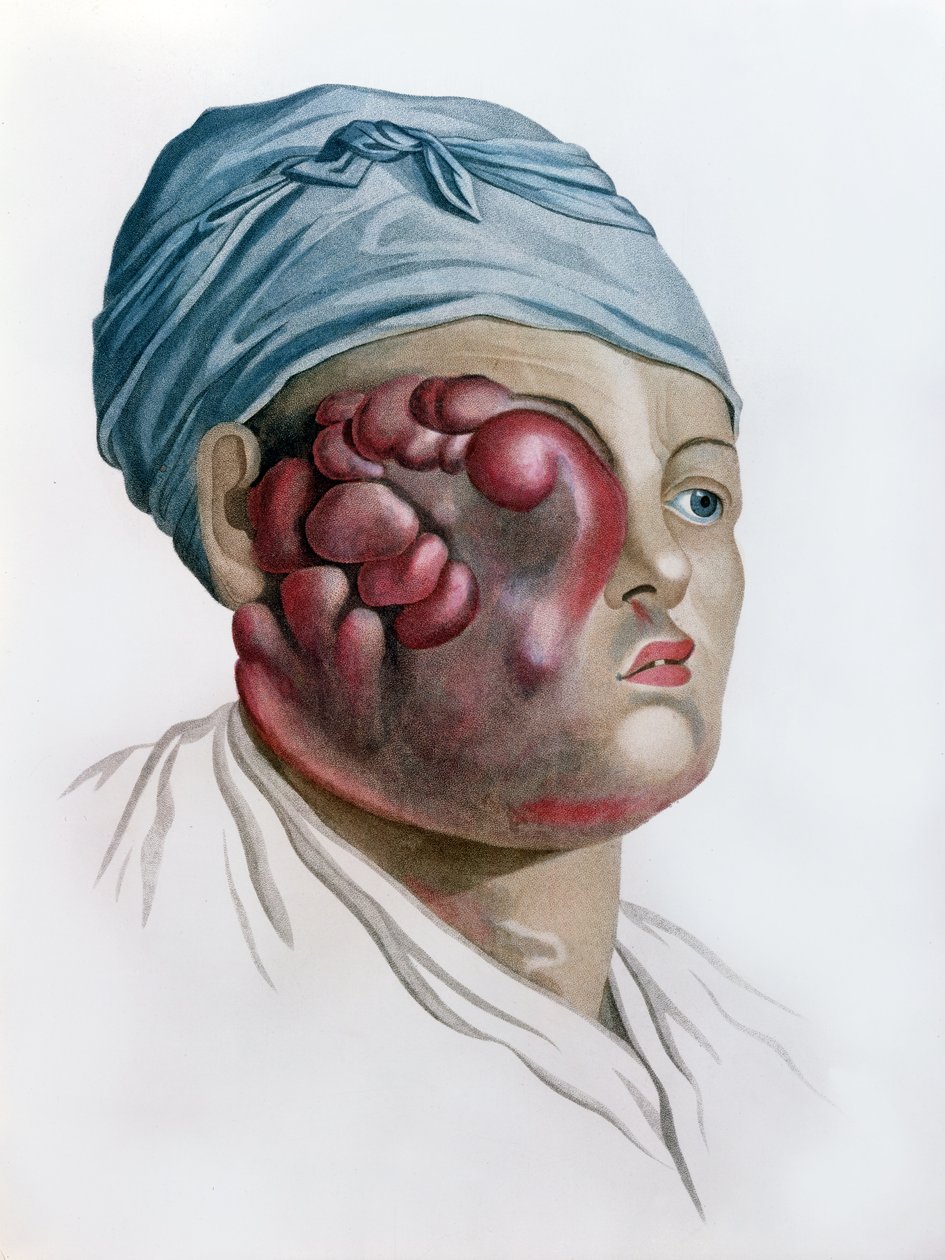 Kanserli skrofula, Baron Jean Louis Alibert (1768-1837) tarafından yazılan Description des Maladies de la Peau, Paris, 1806 by French School
