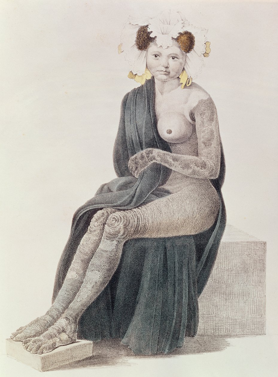 Konjenital İhtiyoz, G.M. Olbers, 1830 by French School
