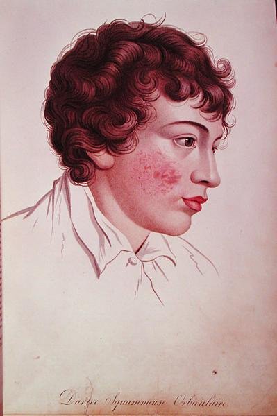 Baron Jean Louis Alibert'in (1768-1837) 'Description des Maladies de la Peau'dan kuru yama by French School