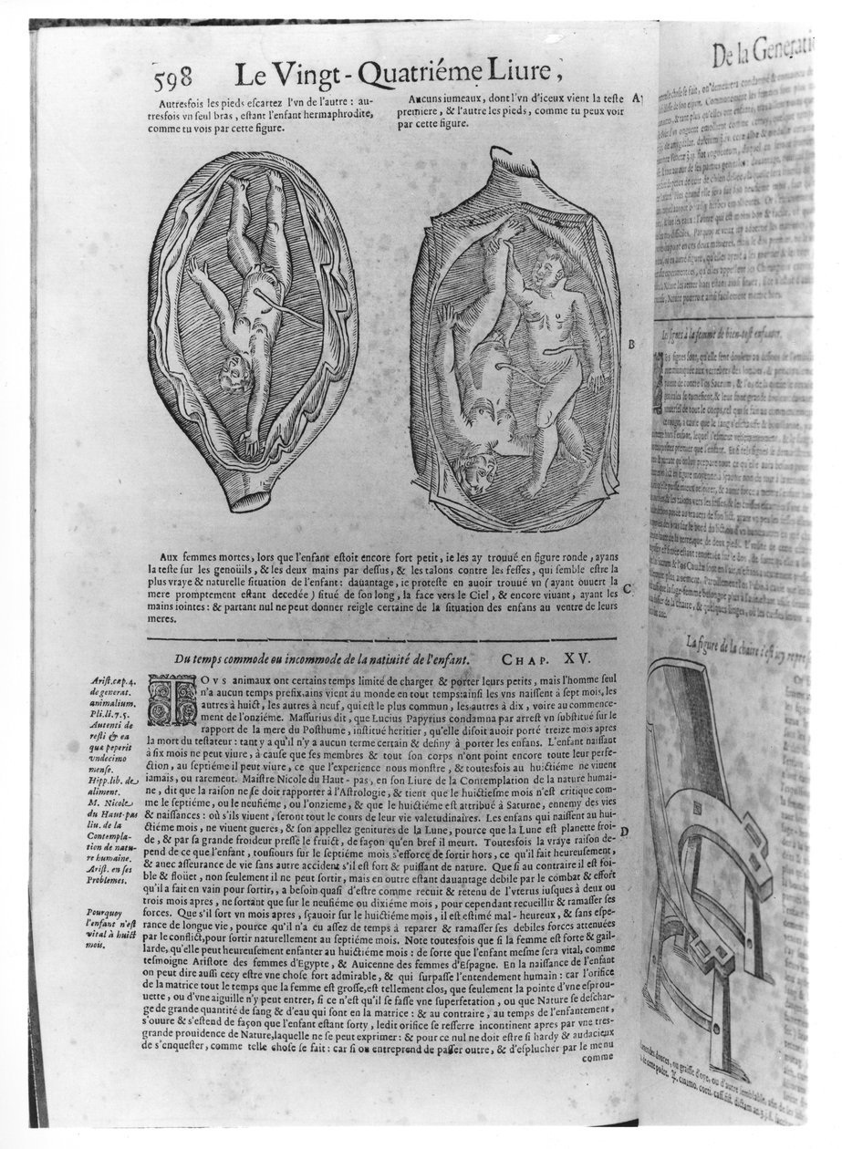 Fötüs, Ambroise Pare (1509-90) tarafından Oeuvres