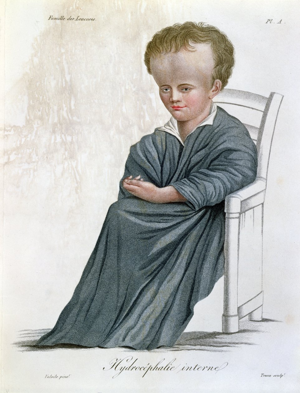 İç Hidrosefali, Baron Jean Louis Alibert (1768-1837) tarafından Nosologie Naturelle