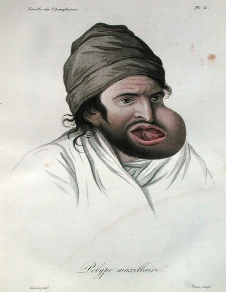 Baron Jean Louis Alibert