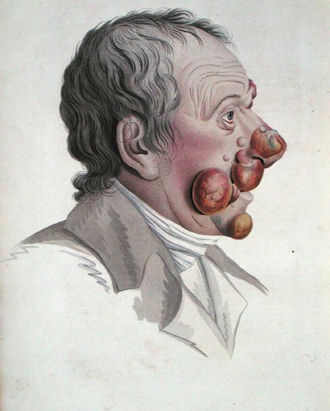 Mikoz Fongoide, Baron Jean Louis Alibert