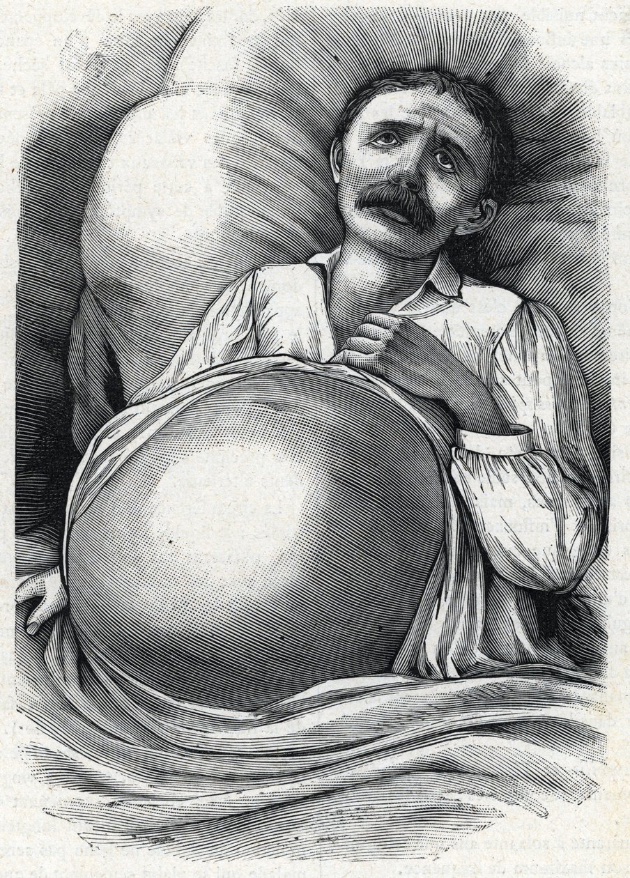 İleri karaciğer sirozu olan hasta (gravür) 1888 by French School
