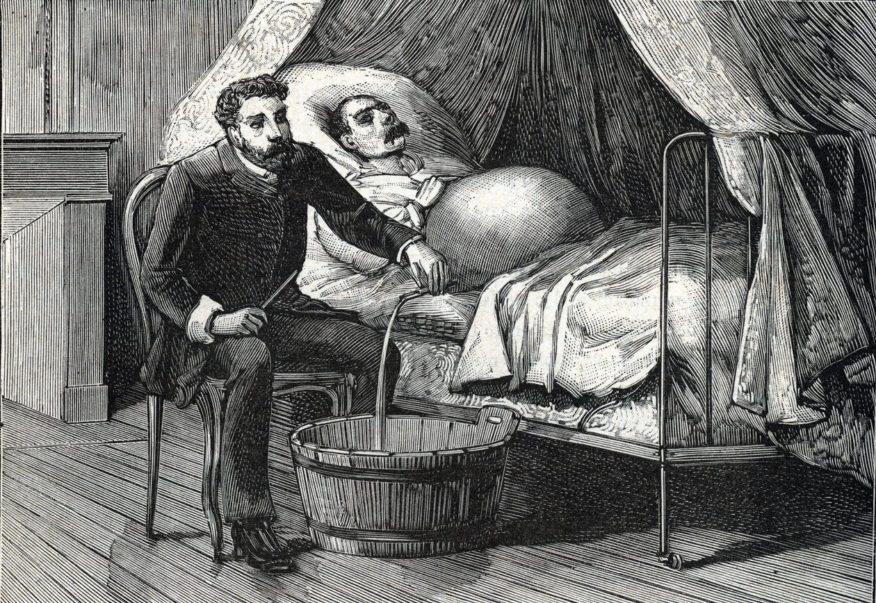 İlerlemiş karaciğer sirozu olan hasta, delik (gravür) yapan doktor 1888 by French School