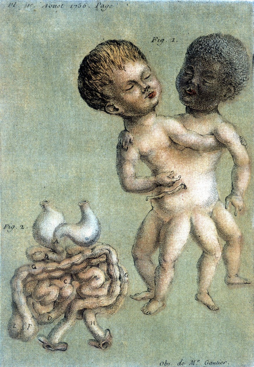 Siyam kardeşleri temsil eden ilaç levhası: beyaz ve siyah. Toussaint'in (1756) "Fizik, Doğa Tarihi ve Sanat Üzerine Periyodik Gözlemler"deki çizimi. by French School