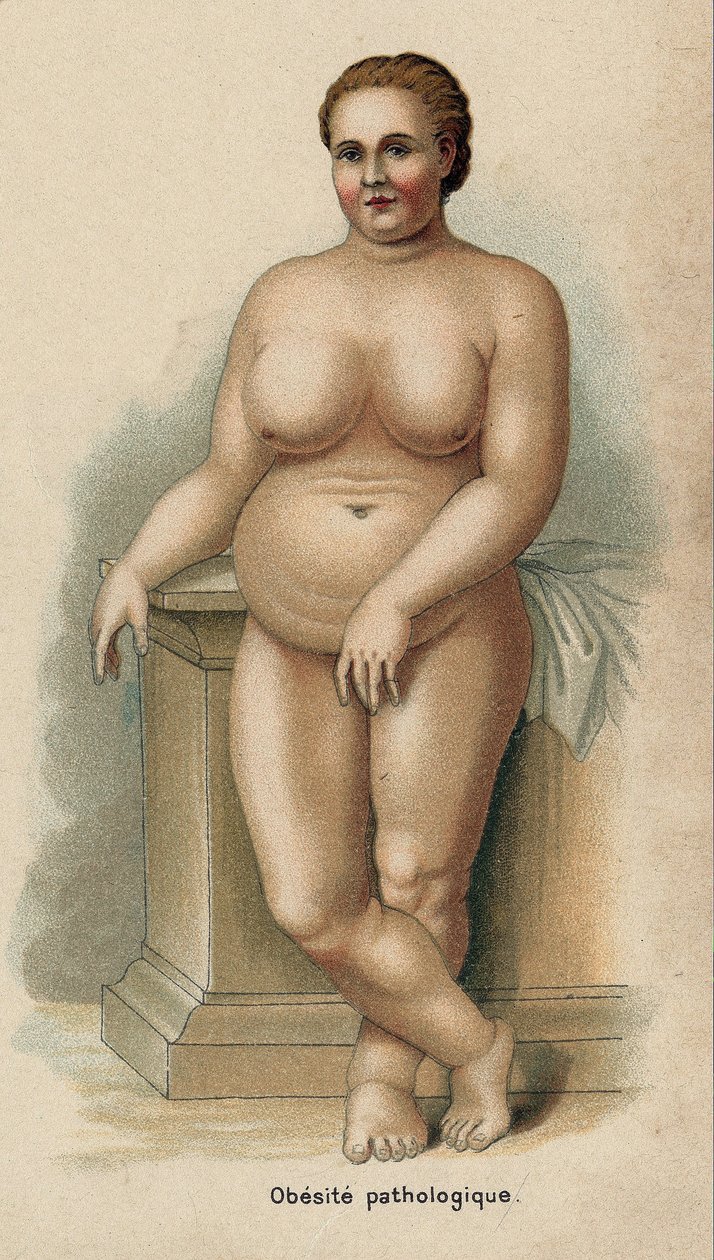 Patolojik obeziteye sahip bir kadın portresi (baskı) by French School