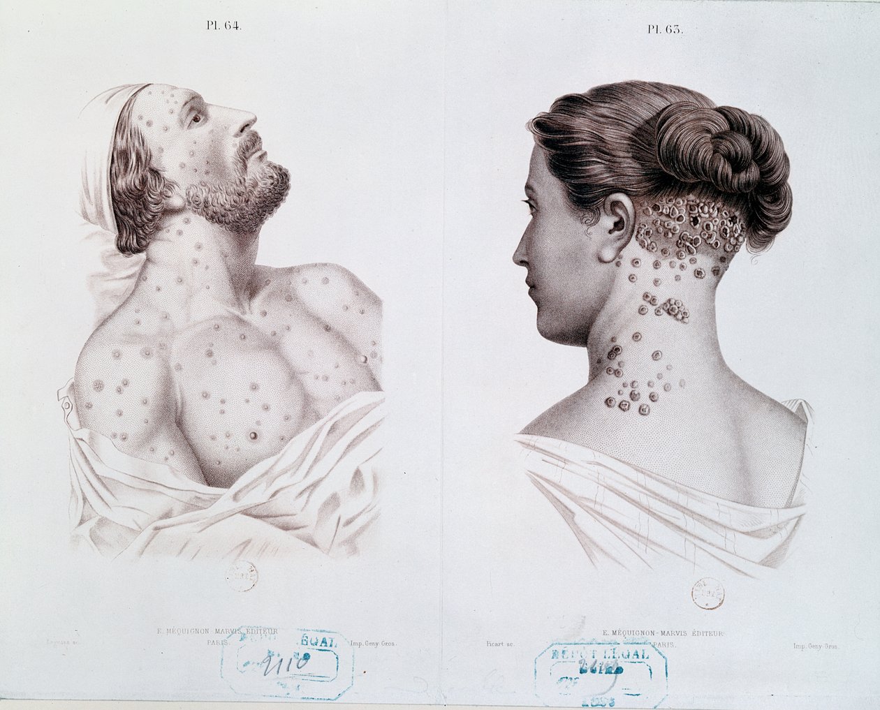 Erkeklerde ve kadınlarda frengi belirtileri, bir tıp kitabından, c.1850-60 by French School