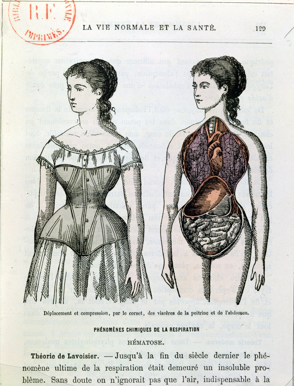 Korsenin Zararlı Etkileri, Dr Jules Rengade (d.1841) tarafından La Vie Normale et la Sante'den bir çizim, c.1880 by French School