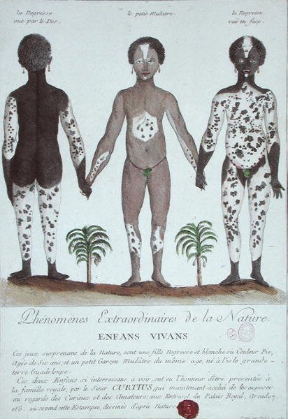 Lökoderma Fenomeni by French School