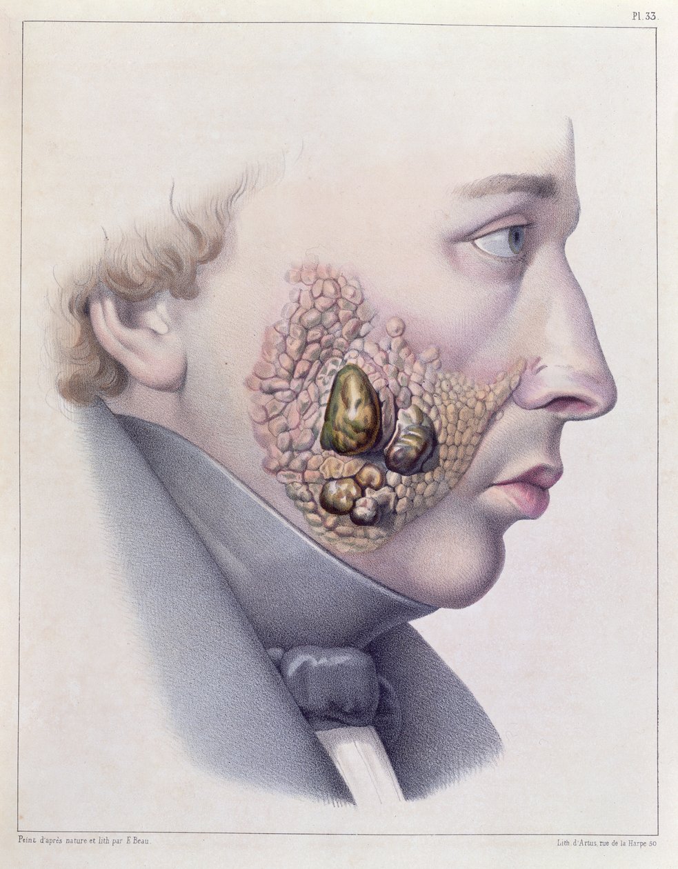 Philippe Ricord (1800-89) 1851 tarafından yazılan Traite Complet des Maladies Veneriennes