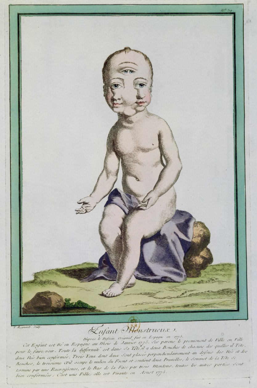 Başı Deforme Olan Çocuk, 