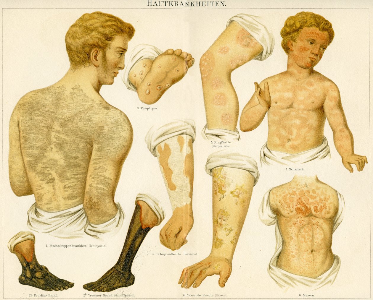 Cilt bozuklukları, c.1890 by German School