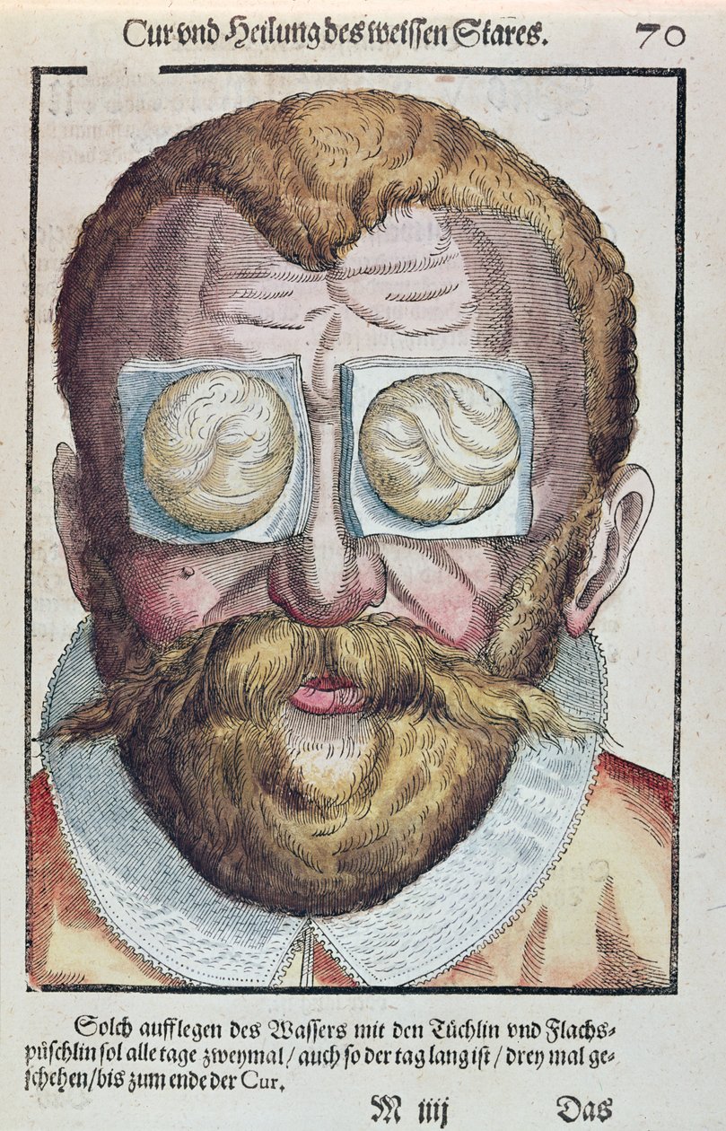 Bir göz rahatsızlığının tedavisi, Georg Bartisch (1535-1636) tarafından Dresden