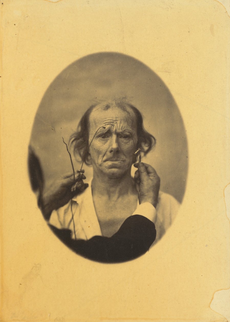  by Guillaume Benjamin Armand Duchenne de Boulogne