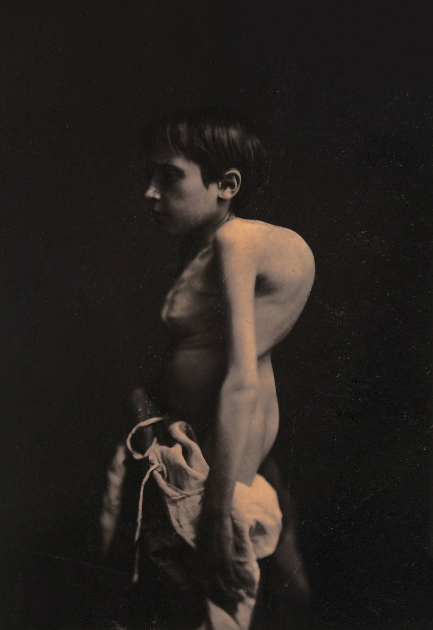Kambur bir çocuğun portresi, c.1855-57 by Guillaume Benjamin Armand Duchenne de Boulogne