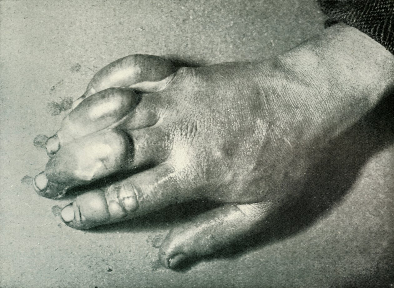 Dr. Atkinsons Frost-Bitten Hand, 5 Temmuz 1911, 1913 by Herbert Ponting