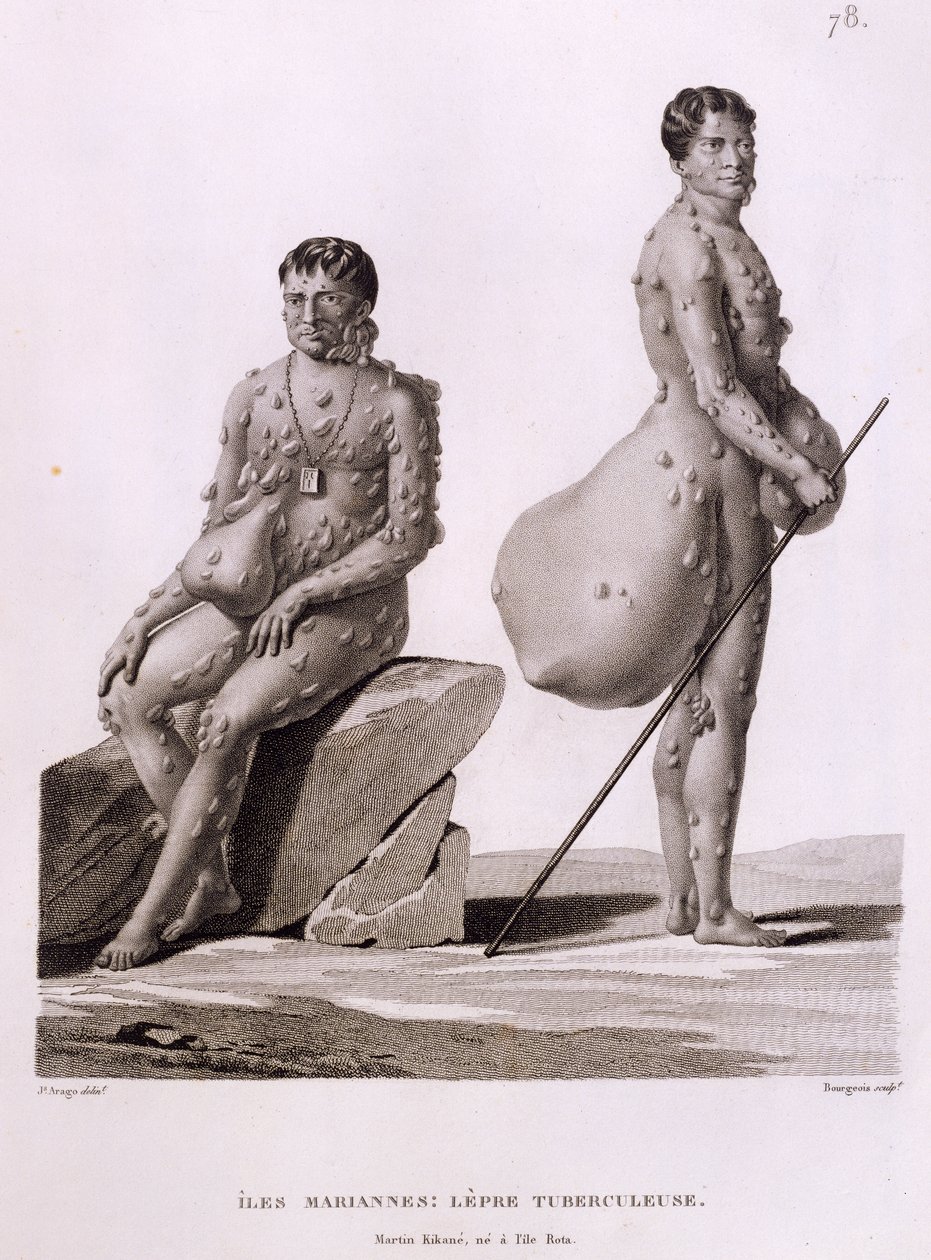 Kuzey Mariana Adaları: Bourgeois tarafından kazınmış 'Voyage Autour du Monde sur les Corvettes de L'Uranie 1817-20'den Tüberkülozdan Acı Çeken İki Adam, 1825 yayınlandı by Jacques Etienne Victor Arago