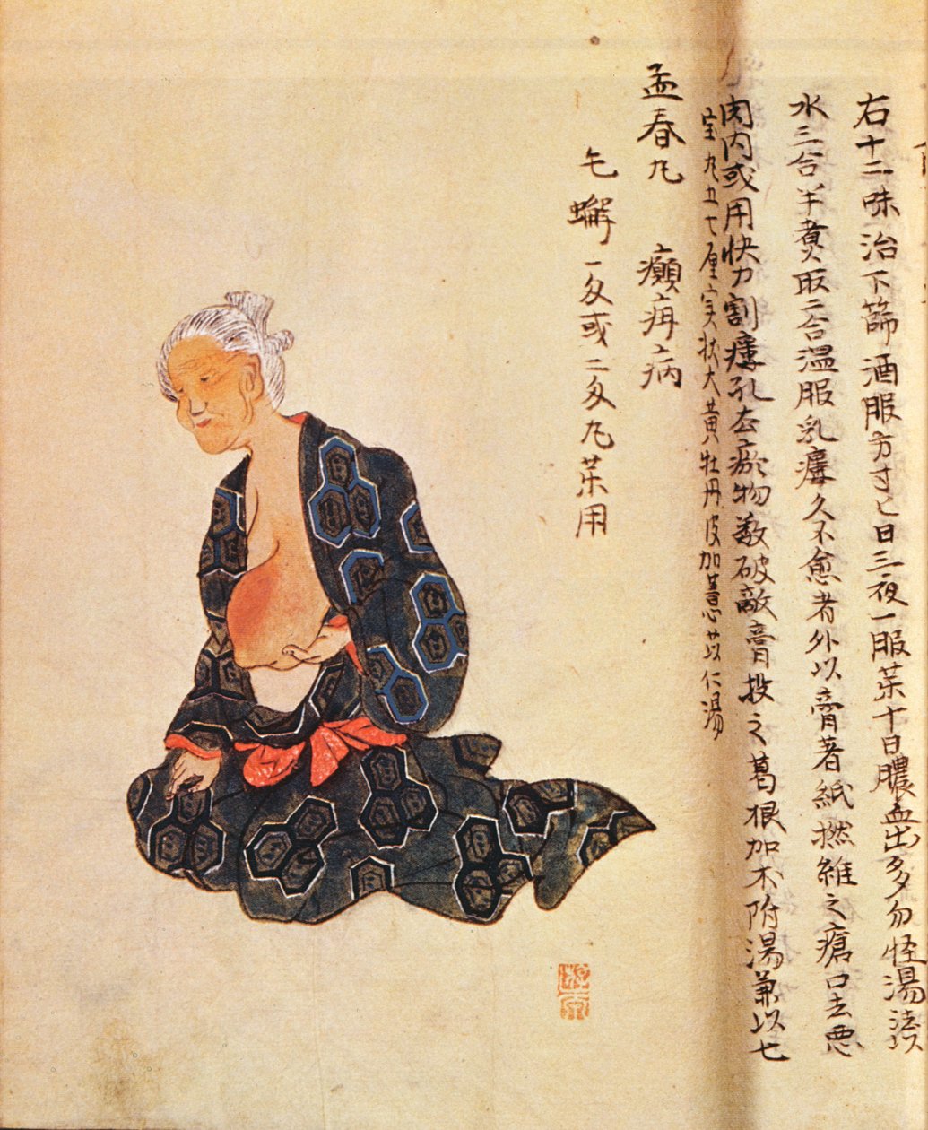 1804 yılında Seishu Hanaoka (1760-1836) tarafından genel anestezi altında gerçekleştirilen meme kanserinin ilk cerrahi tedavisi by Japanese School