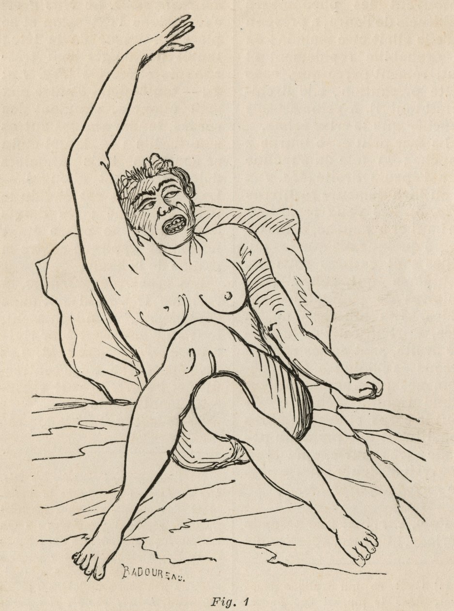 Histerik epilepsi, atak, bükülmeler, şek. 1, Bourneville et P. Regnard, Paris, 1876 tarafından 