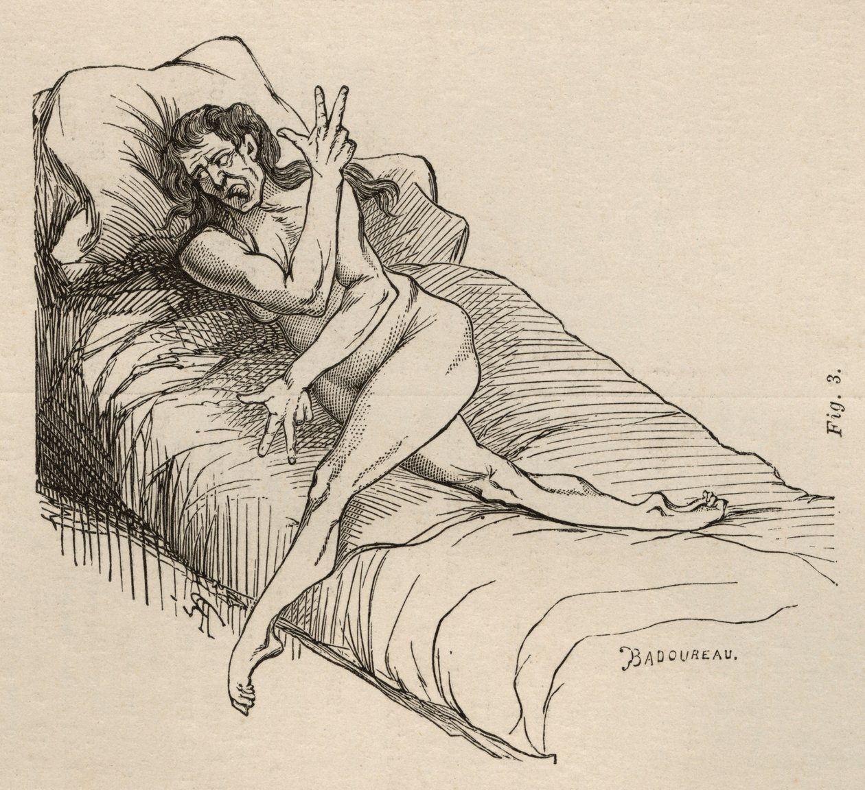 Histerik epilepsi, atak, bükülmeler, şek. 3, Bourneville et P. Regnard, Paris, 1876 tarafından 