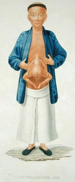 Karnında gelişmemiş yapışık ikizi olan Çinli adam, bir Fransız seyahat kitabından örnek, M. Legrand tarafından oyulmuş (renkli gravür) by Jean Gabriel (after) Pretre