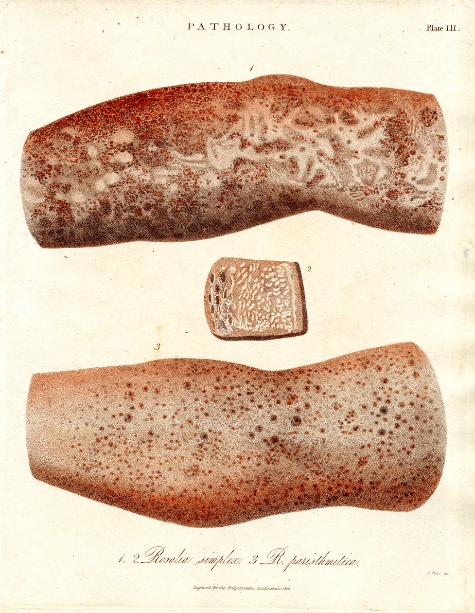 Deri Erüpsiyonları - Roseola simplex ve Roseola paristhmitica by John Pass