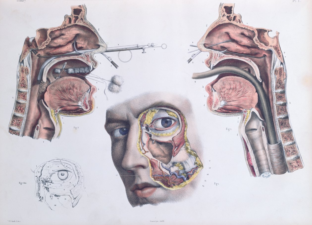Bir Burun Ameliyatı, Jean-Baptiste Marc Bourgery (1797-1849) 1866-67'nin 'Traite Complet de l'Anatomie de l'Homme'dan bir levha by Nicolas Henri Jacob