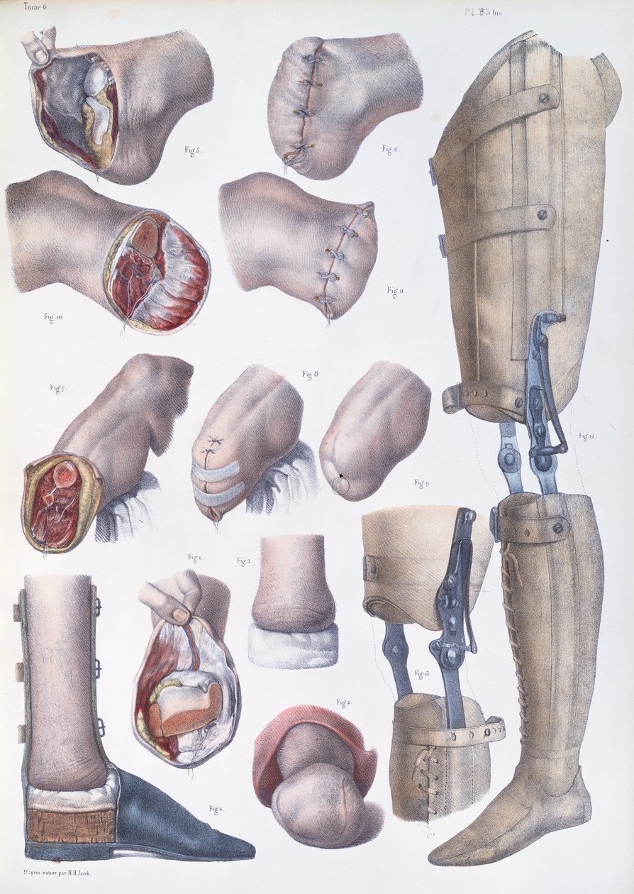 Ampütasyonlar ve Protezler, Jean-Baptiste Marc Bourgery (1797-1849) 1866-67'nin 'Traite Complet de l'Anatomie de l'Homme' adlı eserinden plak by Nicolas Henri Jacob