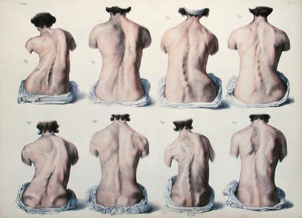 Omurga Deformiteleri, Jean-Baptiste Marc Bourgery (1797-1849) 1866-67 (renkli gravür) tarafından 