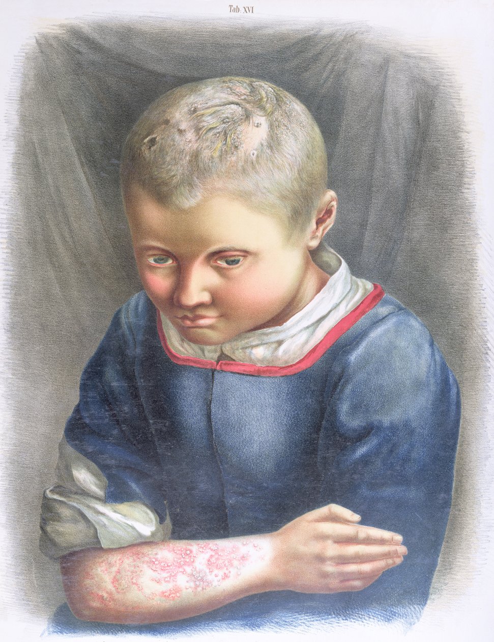 Favus, Daniel Cornelius Danielssen