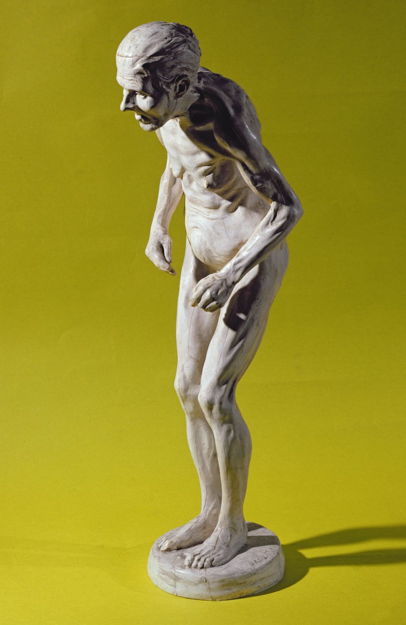 Parkinson Hastalığı olan bir kadın figürü (alçı) by Paul Marie Louis Pierre Richer