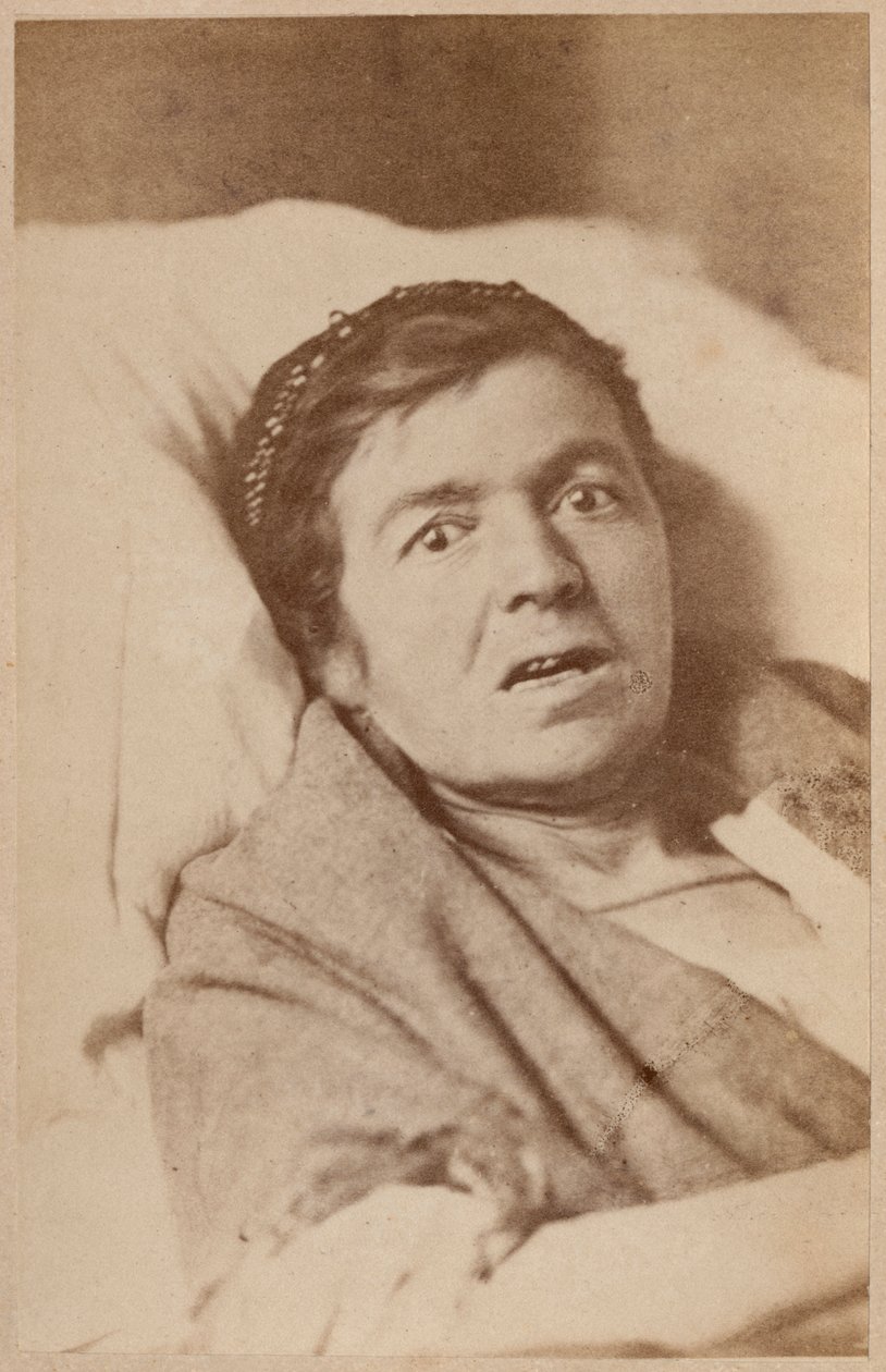 Histerik epilepsi, yüz kasılması, Bourneville ve P. Regnard'ın 'Iconographie Photographique de La Salpetriere' adlı eserinden VIII. plaka, Paris, 1876 (albüm baskısı) by Paul Regnard